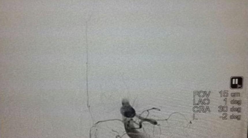 (&ouml;zel) Her Altı Saniyede Bir Kişi İnme Ge&ccedil;iriyor