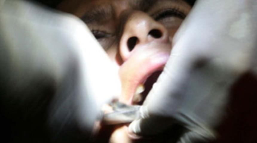 Diş &ccedil;&uuml;r&uuml;mesi tarih oluyor