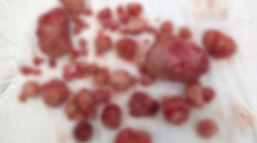 Hastanın Rahminden 81 Adet Miyom &Ccedil;ıktı