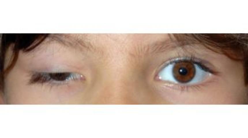 G&ouml;z Kapağı D&uuml;ş&uuml;kl&uuml;ğ&uuml; Deyip Ge&ccedil;meyin