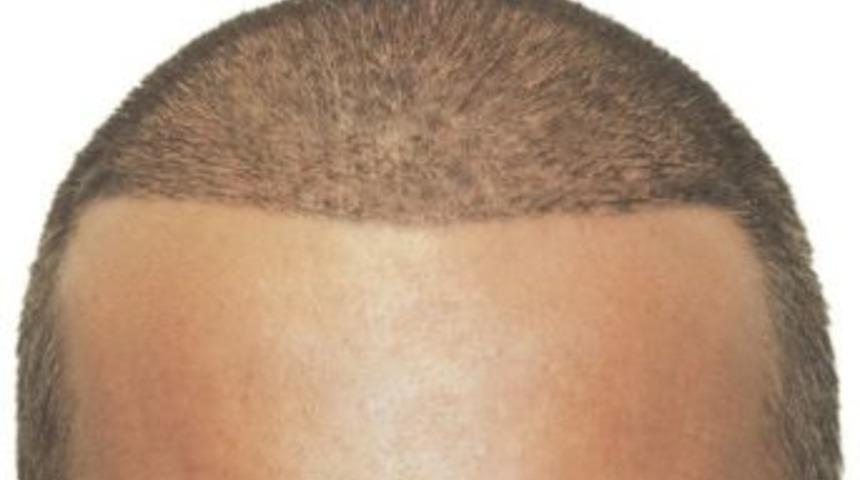 Sa&ccedil; Ekimi &Ouml;ncesi Bunlara Dikkat