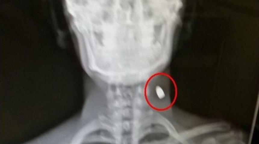 X-ray Cihazı İkaz Verince Boynunda Mermi Olduğu Ortaya &Ccedil;ıktı