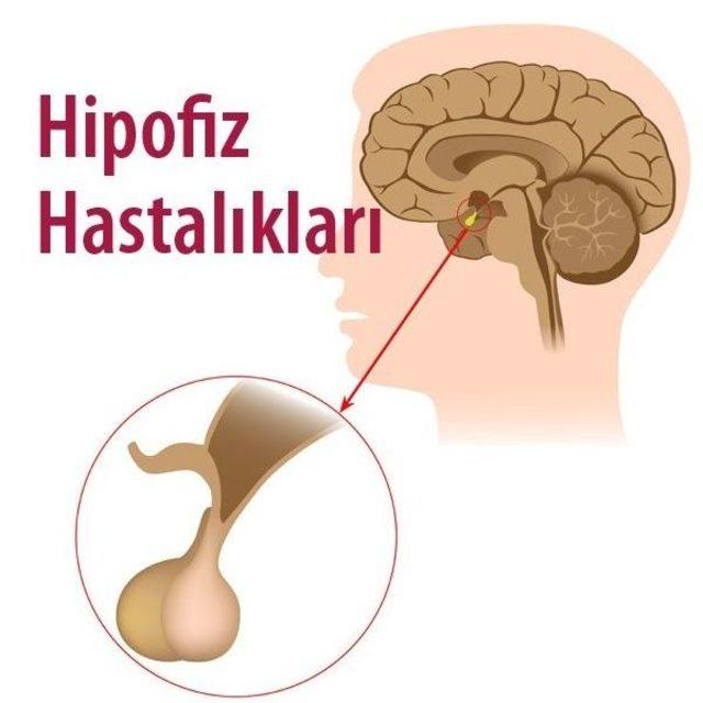 Ga&uuml;n&rsquo;de Endoskopik Hipofiz Ameliyatları Başladı 1
