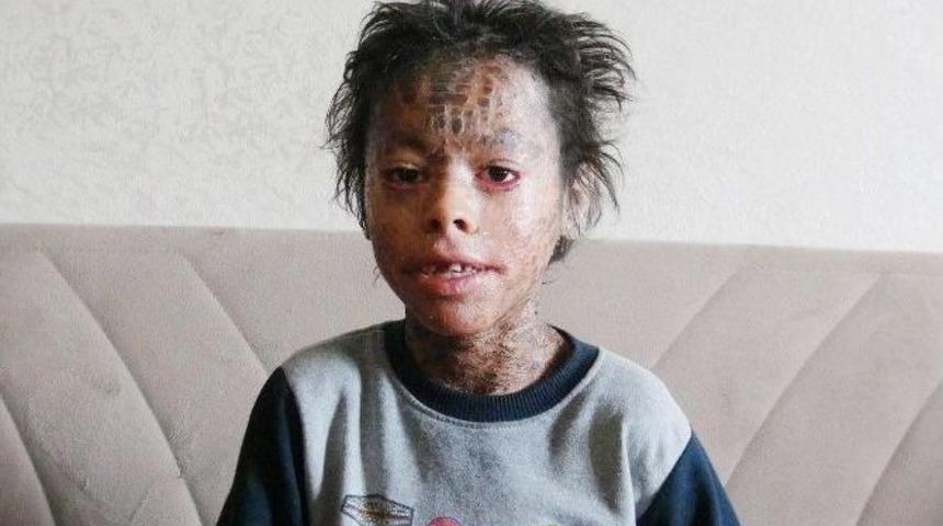 K&uuml;&ccedil;&uuml;k Melih İyileşiyor