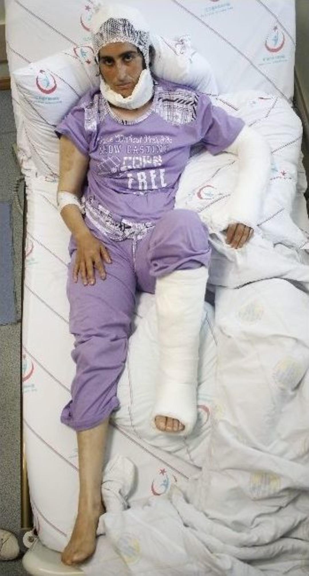 Kafasında K&uuml;rek Kırılan Ve Kafa Derisi Y&uuml;z&uuml;len Gen&ccedil; Kadının Tedavisi 2 Ay S&uuml;recek