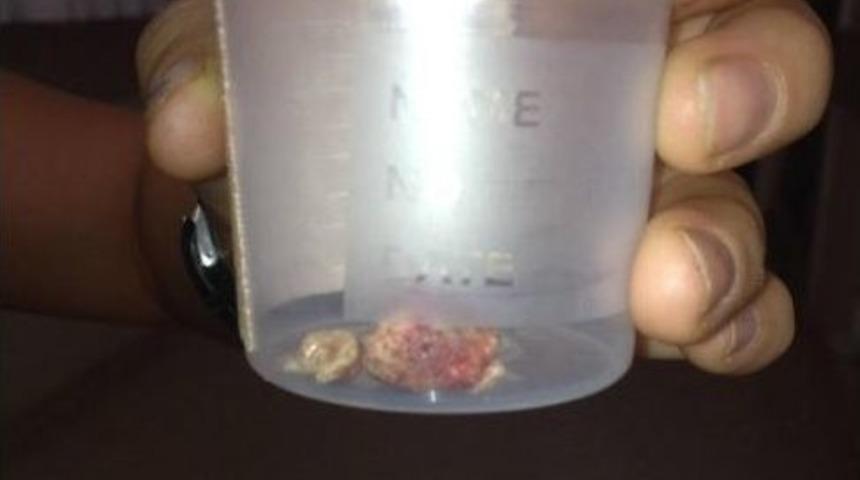 T&uuml;k&uuml;r&uuml;k Bezinden 3 Santimetrelik Taş &Ccedil;ıktı