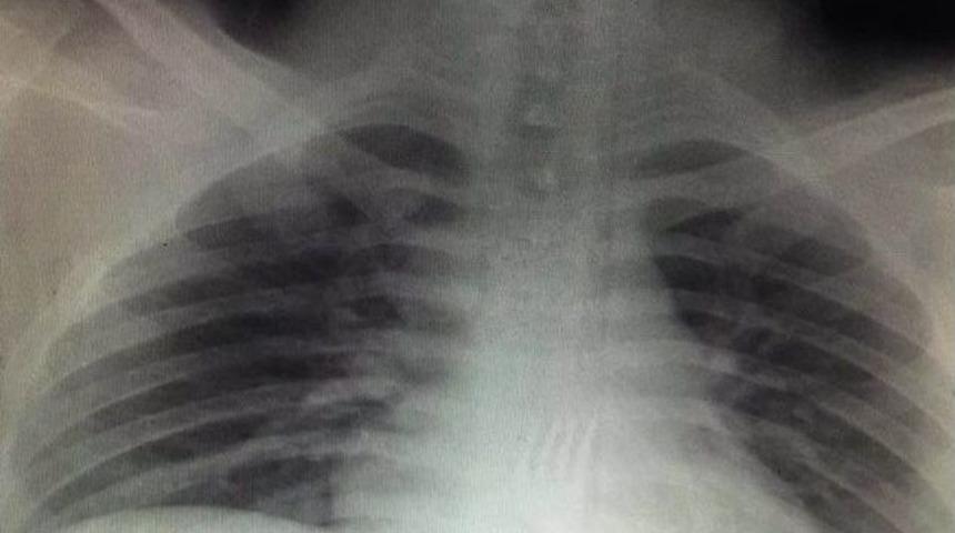 Midesinden 15 Santimetrelik &Ccedil;atal &Ccedil;ıktı