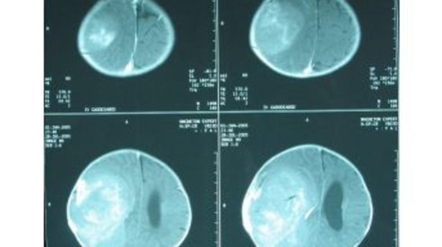 &Ccedil;ocuklarda Beyin T&uuml;m&ouml;r&uuml; Belirtileri Erişkinlerden Farklı