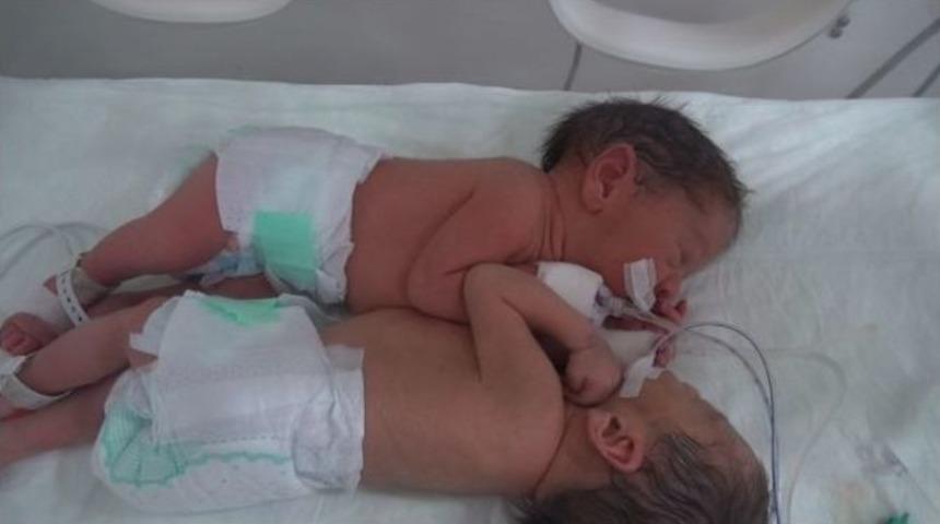 Siyam İkizleri Başarılı Ameliyatla Ayrıldı