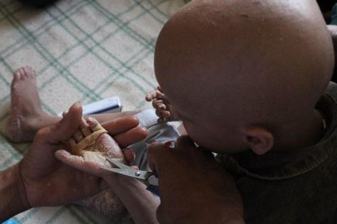 Suriyeli &Ccedil;ocuğun İyileşmeyen Hastalığı