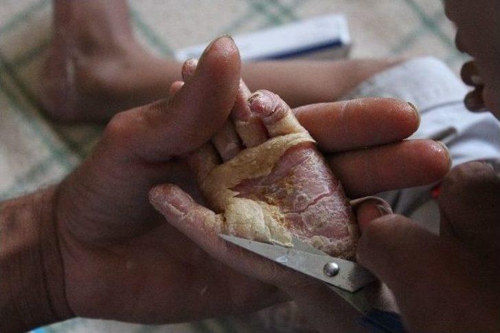 Suriyeli Çocuğun İyileşmeyen Hastalığı G1