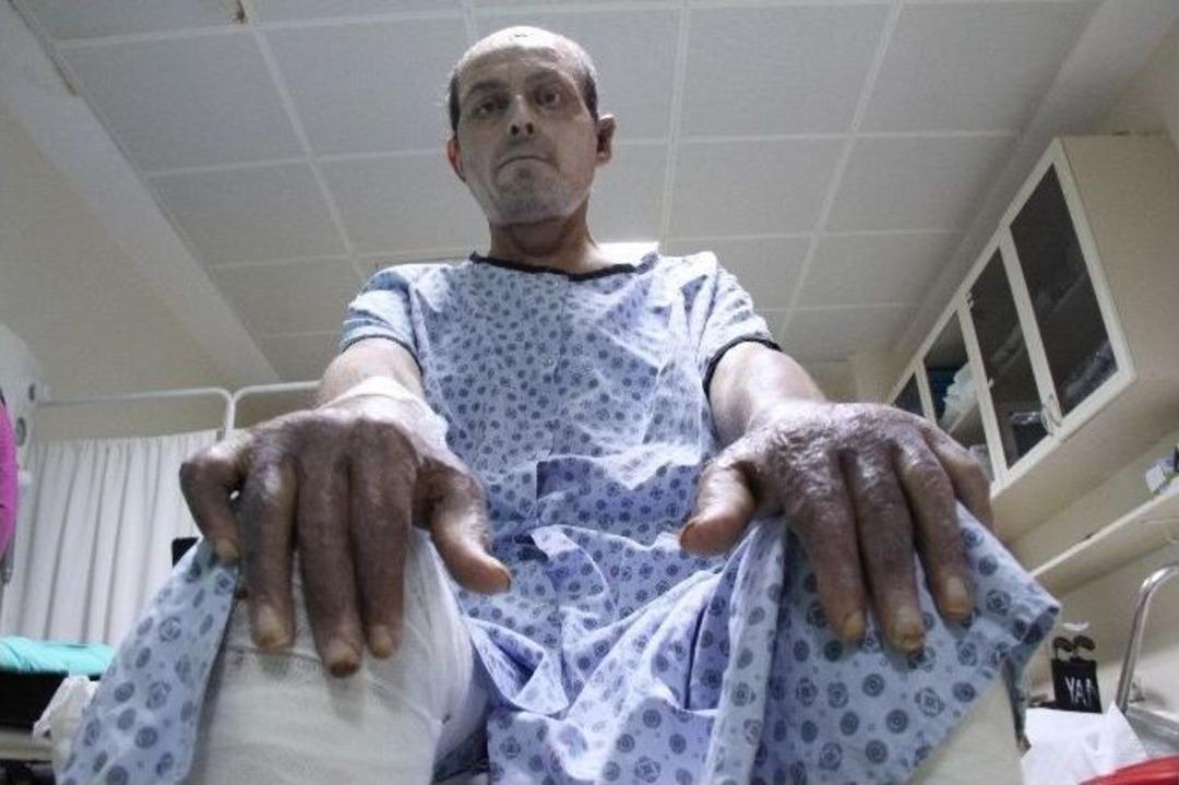 (&ouml;zel Haber) Alevlerin Arasından &Ccedil;ıkarak İkinci Hayatlarına Tutundular