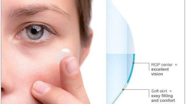 Keratokonus Tedavisinde Kontakt Lens Kullanımı