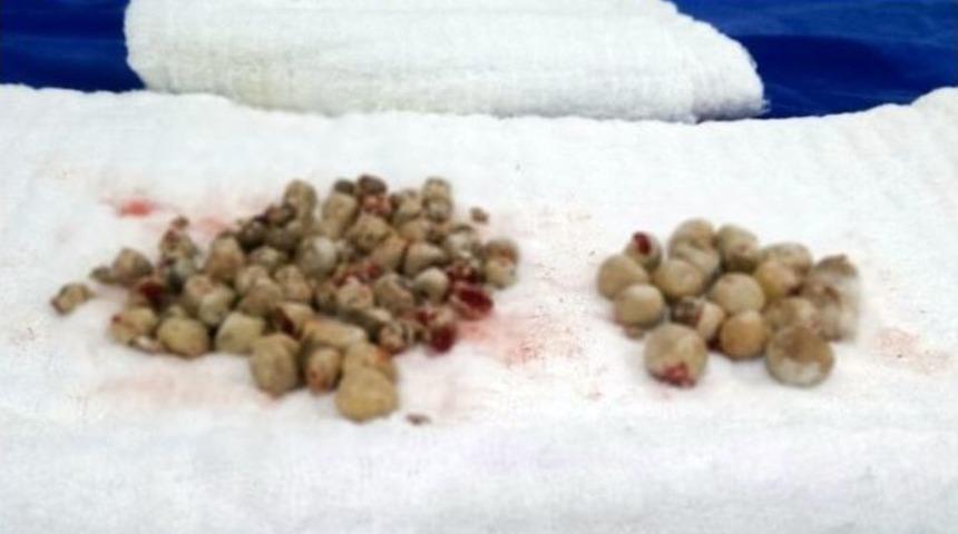 (&ouml;zel Haber) Bu Taşlar Doktoru Da Şaşırttı