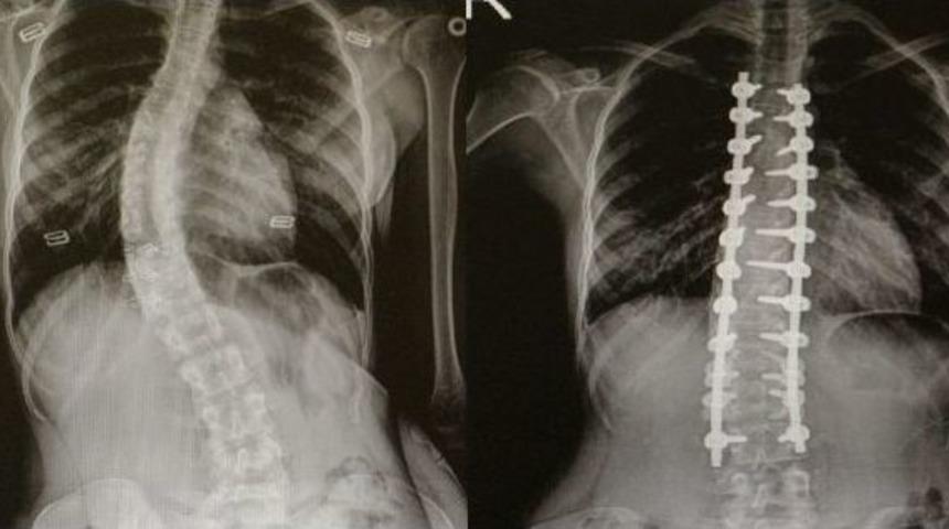 Omurga Eğriliği Olanlar Om&uuml;&rsquo;de Şifa Buluyor