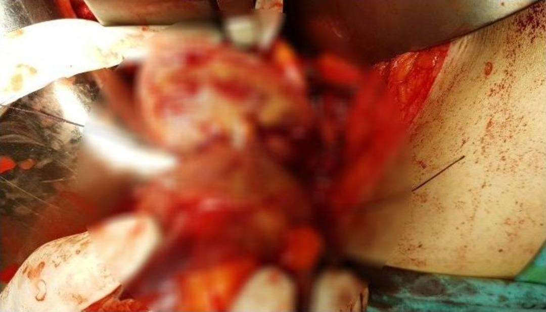 B&ouml;breğinden 550 Gramlık T&uuml;m&ouml;r &Ccedil;ıkarıldı