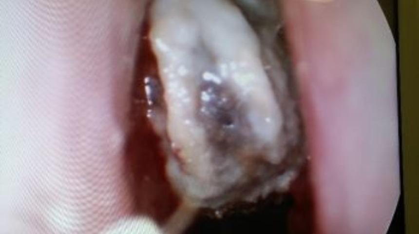 Yozgat&rsquo;ta 5 Yaşındaki Kız &Ccedil;ocuğunun Burnundan Zeytin &Ccedil;ekirdeği &Ccedil;ıkartıldı