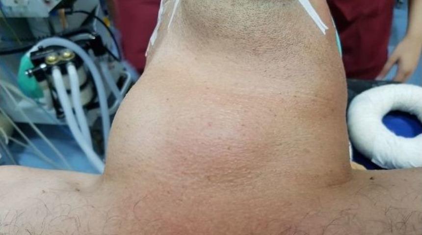 Boğazından 2 Kilogram Kitle &Ccedil;ıkarıldı