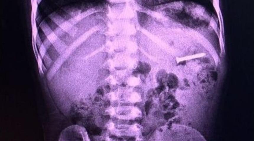 3 Yaşındaki Minik Bahadır&rsquo;ın Yuttuğu 2,5 Santimetrelik Vida &Ccedil;ıkarıldı