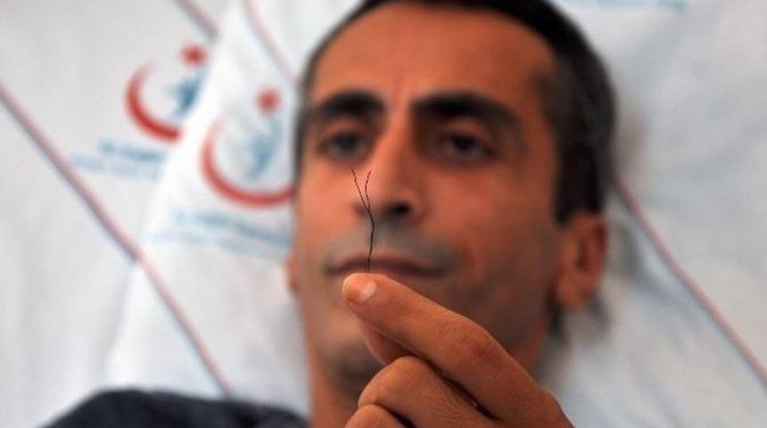 Karın Ağrısı İle Gittiği Hastanede Bağırsağında 2 Tane 10 Santimetre Tel &Ccedil;ıktı