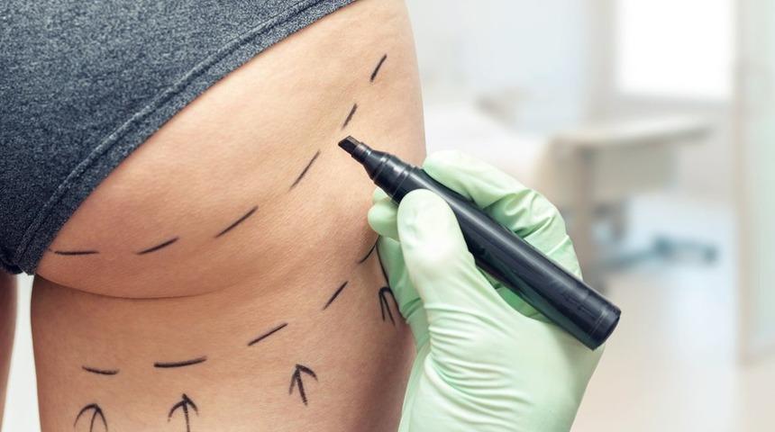 Brezilya tipi kal&ccedil;a kaldırma ameliyatı riske değer mi?