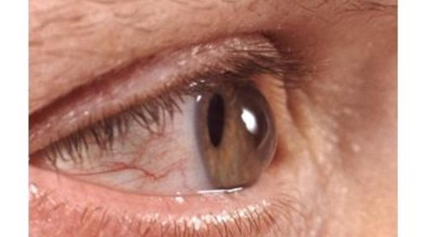 G&ouml;zlerini Ovuşturanlar Dikkat