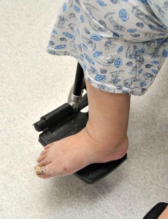 Aşırı Kilo Felce Bile Neden Olabiliyor 1