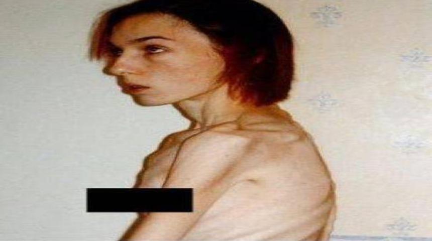 Anoreksiyanın ardından hayata tutundu