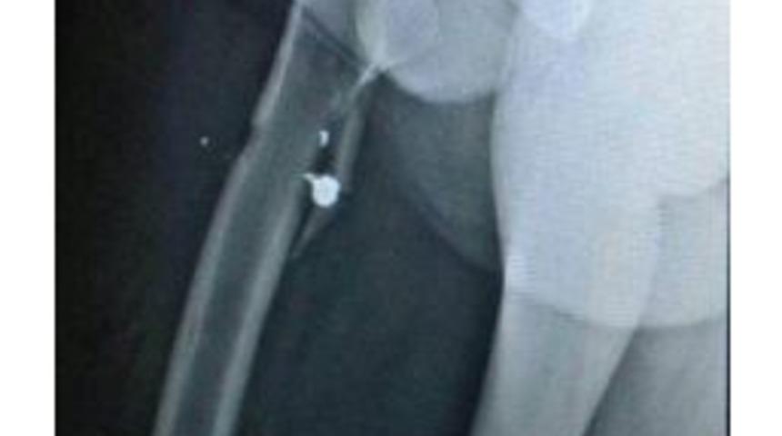 Chp'li Tezcan, Hayati Tehlikeden 1 Santimle Kurtulmuş (2)