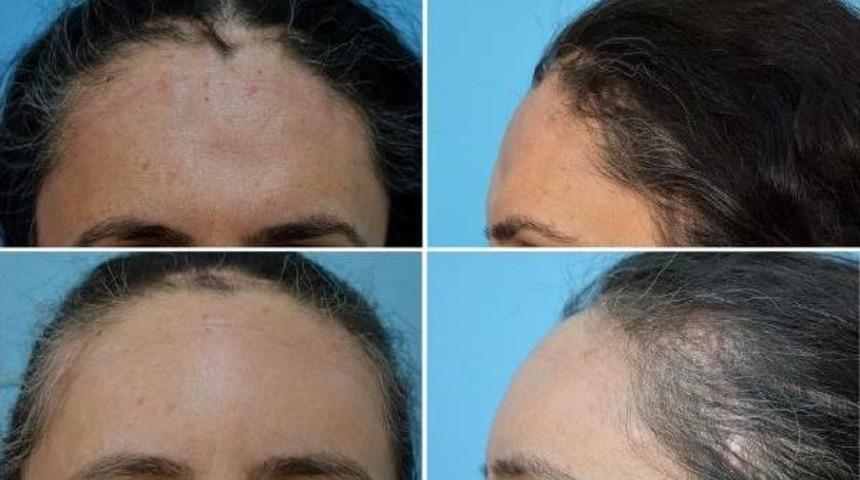 Kafatası &Ccedil;&ouml;ken Kadına, Titanyum Plakalı Tedavi