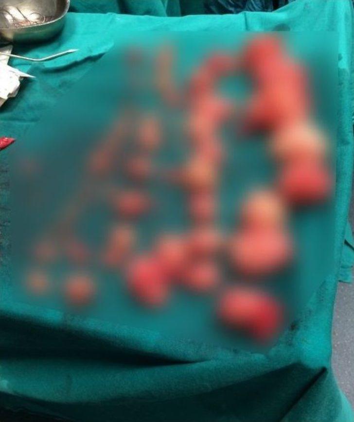 Şişen Karnından Çıkanlar Şaşırttı G5