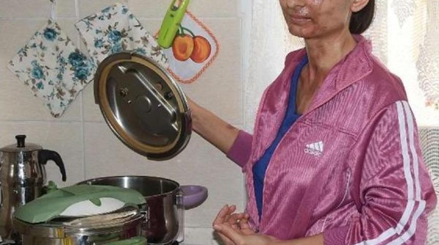 Düdüklü Tencere Bomba Gibi Patladı, Yüzü Tanınmaz Hale Geldi