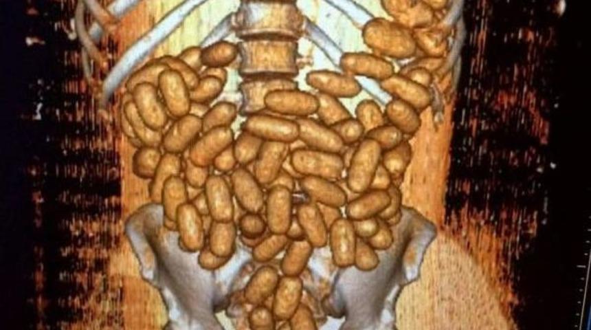 Nijrya Uyruklu Ka&ccedil;ak&ccedil;ının Sindirim Sisteminde 115 Kaps&uuml;l