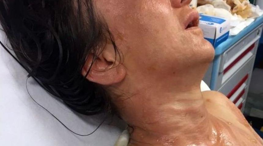 Kaynananın Gelinini Kızgın Yağ İle Yaktığı İddiası