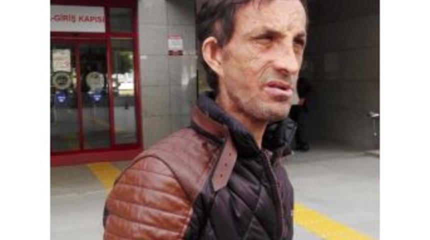 Y&uuml;z Nakilli Uğur Acar: Ramazan Kaya Sigarasını Yakarken Kendini Yaktı