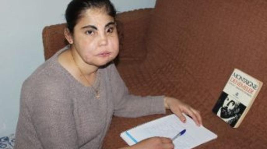 T&uuml;rkiye&rsquo;nin Y&uuml;z Nakli Yapılan İlk Kadını Hayatını Kaybetti