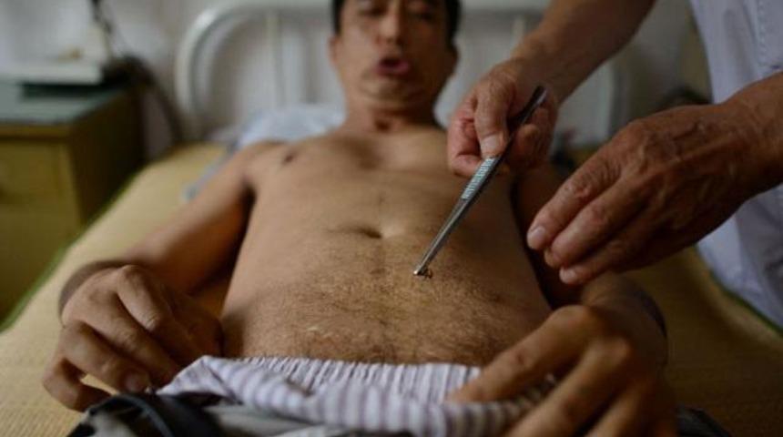 Kansere karşı 'arı sokması'