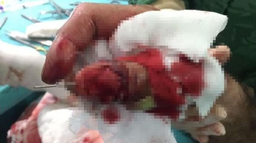 Marangozun Kopan Parmağı Devlet Hastanesinde Dikildi