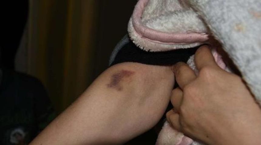 Suriyeli Bebek Ve Anneyi Fareler Kemirdi