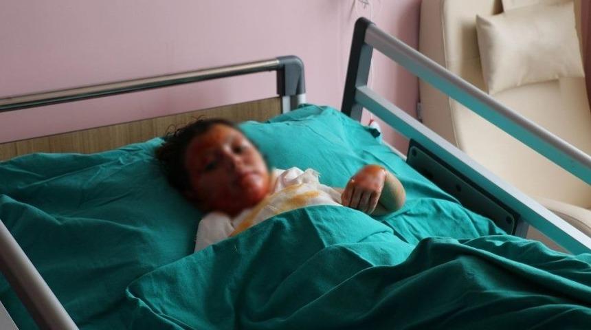 Halep&rsquo;te Soba Yakarken Yanan Kardeşler Sivas&rsquo;ta Tedavi G&ouml;r&uuml;yor