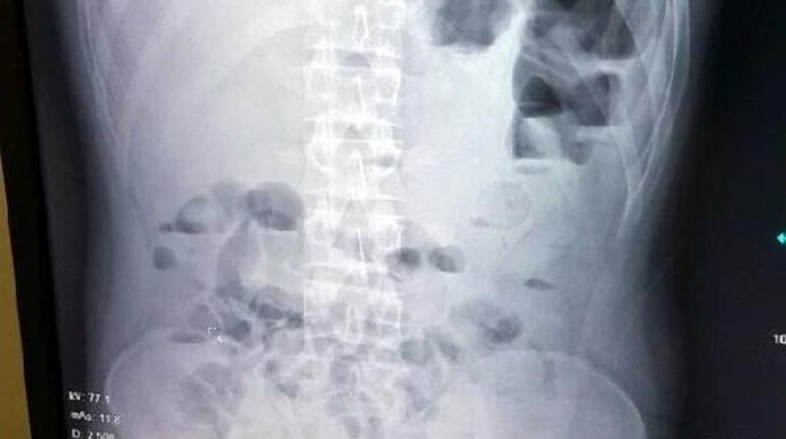 Afgan Uyruklu Uyuşturucu Kuryenin Midesinden 1 Kilo Eroin &Ccedil;ıktı