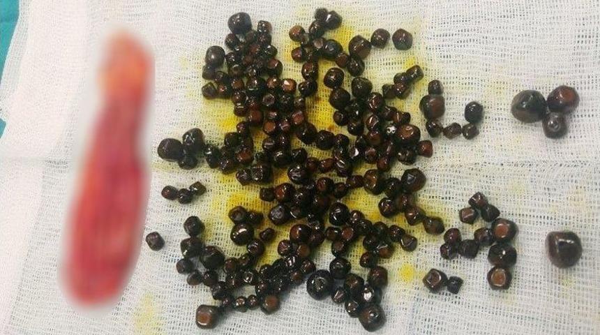 Safra Kesesinden 200 Tane Taş &Ccedil;ıkardılar