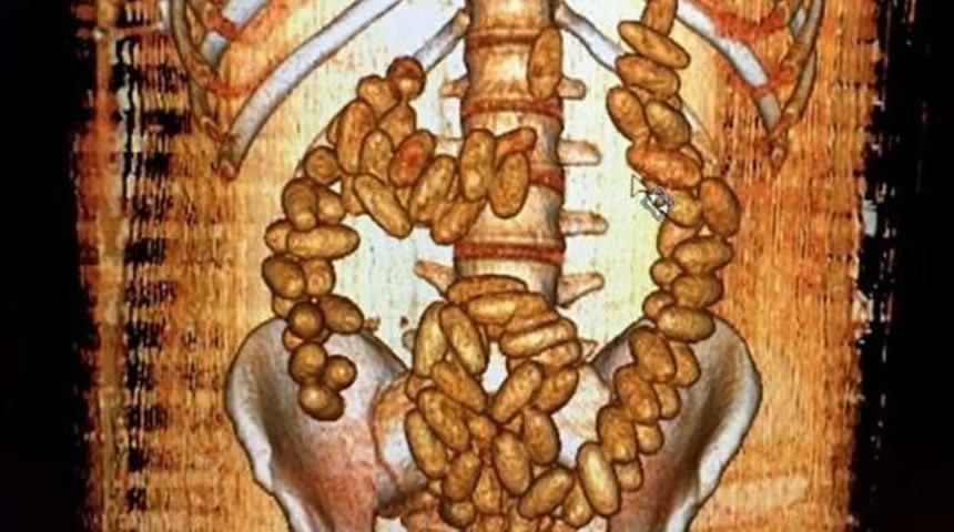 Midelerinde 317 Prezervatif I&ccedil;inde Esrar Ele Ge&ccedil;irildi