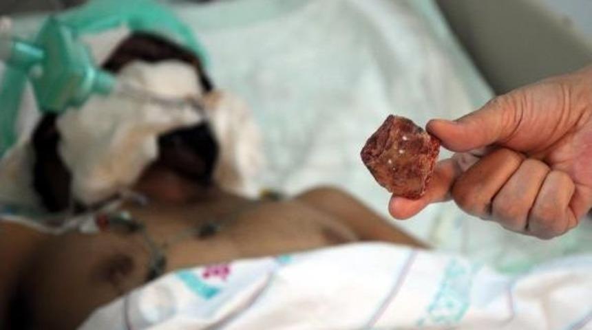 Patlamada Kafasına Saplanan Taş Ameliyatla &Ccedil;ıkartıldı