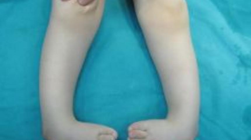 &Ccedil;arpık Ayak Sorununun Tedavisi M&uuml;mk&uuml;n