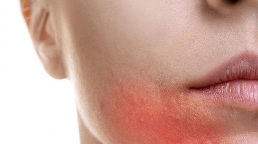 Akneye Yol A&ccedil;an 10 &Ouml;nemli Neden