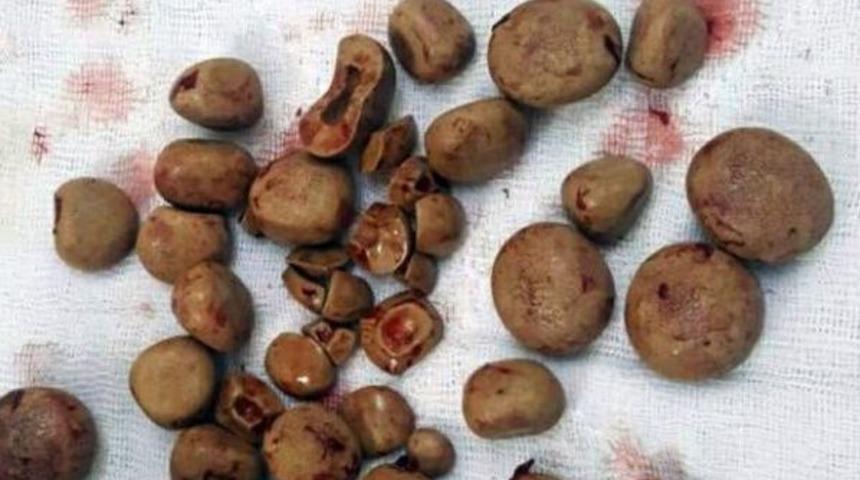 İdrar Torbasından 300 Gram Ağırlığında 40&rsquo;ın &Uuml;zerinde Taş &Ccedil;ıkartıldı