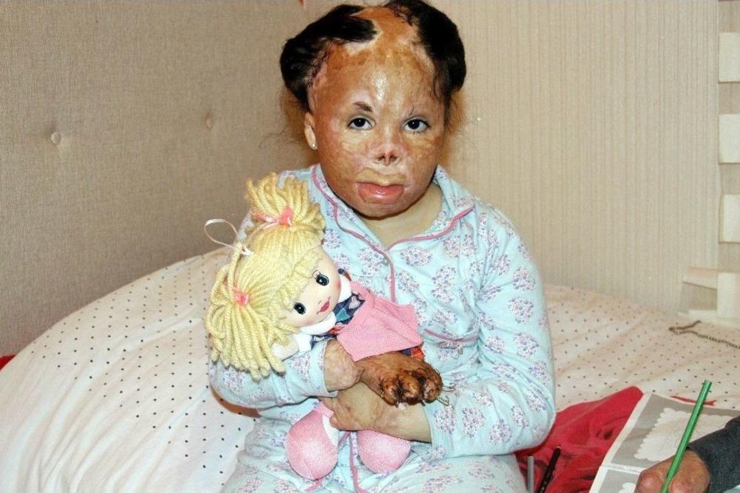 Halep&rsquo;te Bombalı Saldırıda Elleri Ve Y&uuml;zleri Yanan Suriyeli Kardeşlerin Yardım &Ccedil;ığlığı