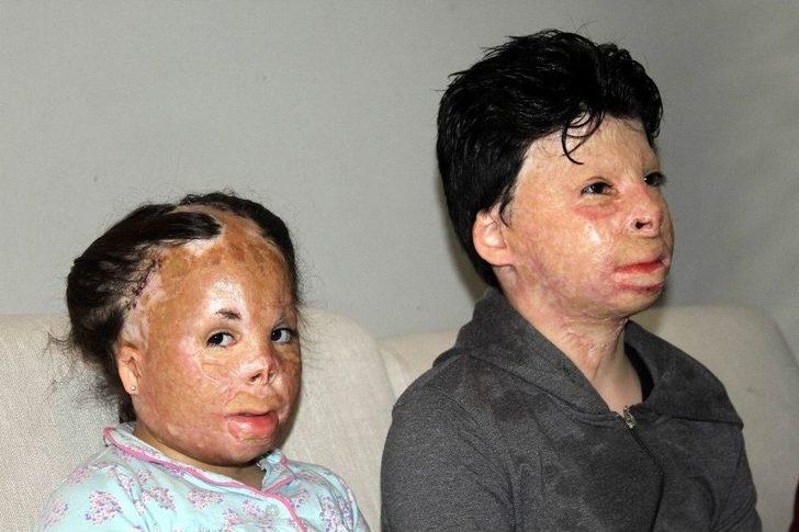 Halep’te Bombalı Saldırıda Elleri Ve Yüzleri Yanan Suriyeli Kardeşlerin Yardım Çığlığı G2