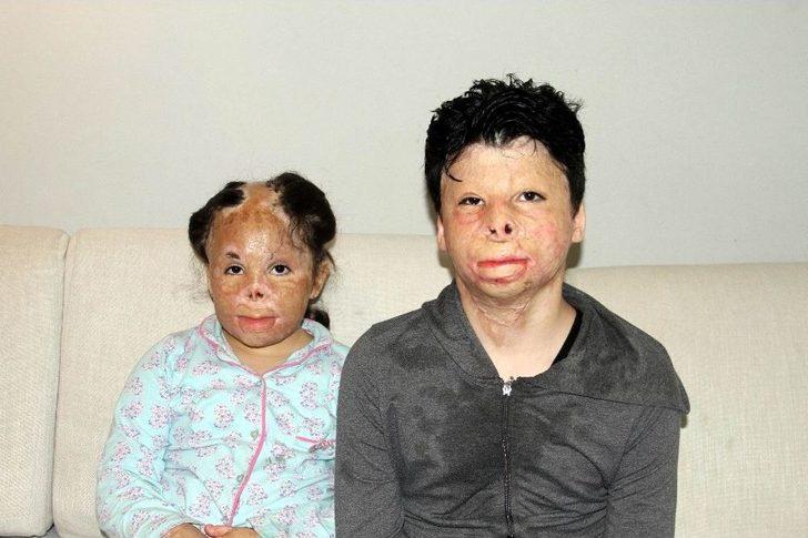 Halep’te Bombalı Saldırıda Elleri Ve Yüzleri Yanan Suriyeli Kardeşlerin Yardım Çığlığı G3